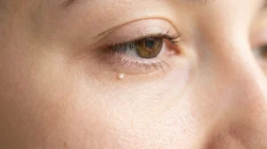 Petit point blanc sous les yeux comprendre les causes et les solutions